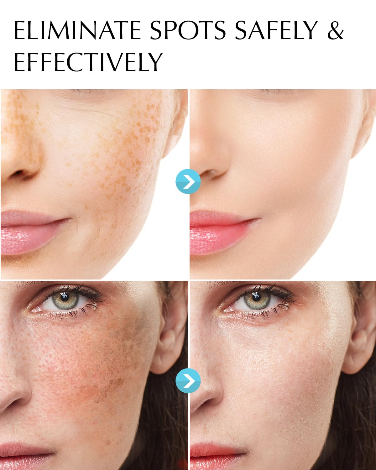 Dark Spot Remover for Face and Body: Hyperpigmentation Treatment - Natural Ingredient - Freckle/Melasma/Sun Spot/Age Spot Remover - Dark Spot Corrector Cream for Women and Men
